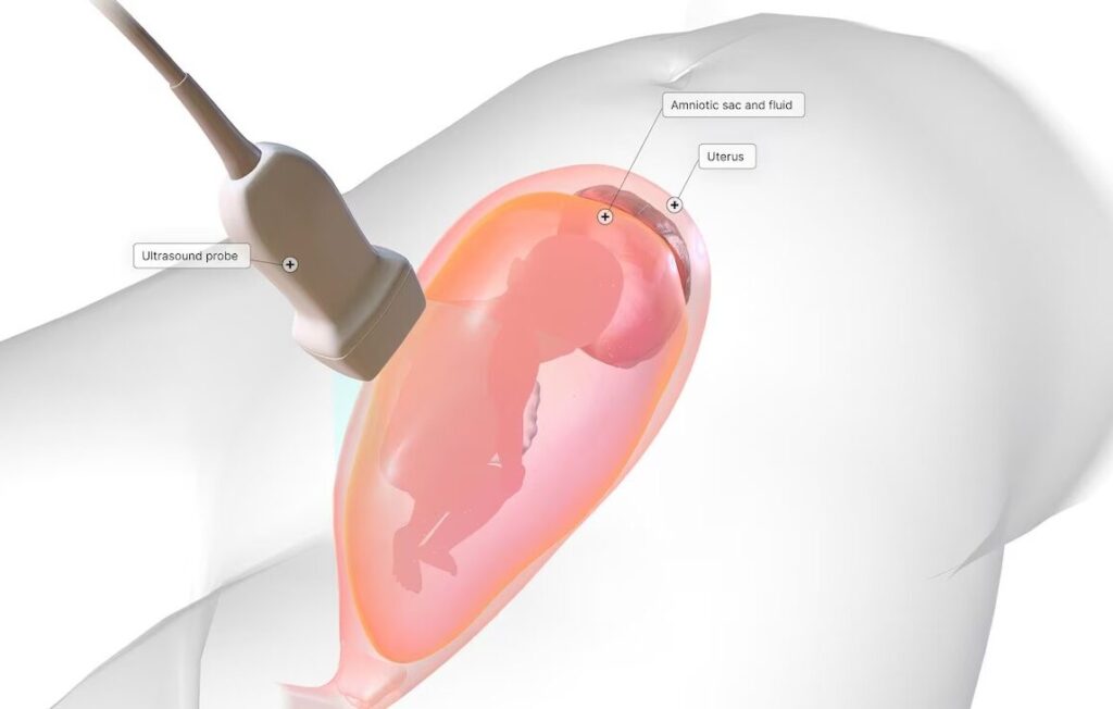 Amniocentesis in Indore