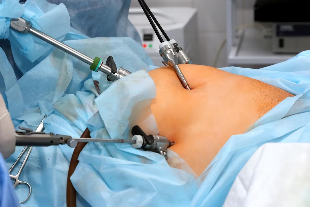 Laparoscopic Hysterectomy in Indore, Sutureless hysterectomy in Indore , hysteroscopy in Indore